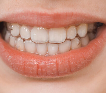 How Oral Exams Can Detect Bruxism (Teeth Grinding) and Its Effects